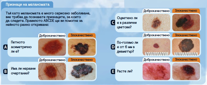 12 начина да разберете дали бенките ви алармират за рак на кожата - За ...